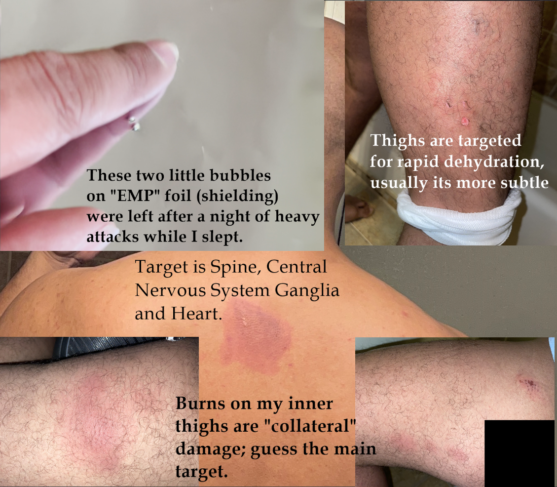 Visible burn